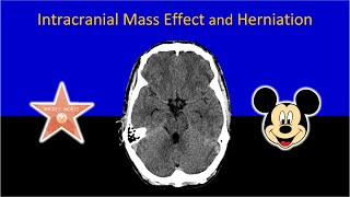 Imaging of Intracranial Mass Effect and Brain Herniation Made Easy