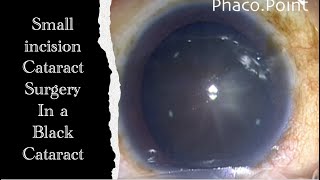 SICS (manual Small Incision Cataract Surgery) - in a black cataract.