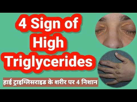 Sign of high triglycerides| Skin marker of high triglycerides