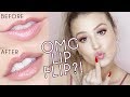 Botox Lip Flip VS Lip Filler