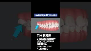 Crossbite Fixed with Invisalign