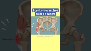 DOLOR DE CADERA PUEDE SER BURSITIS TROCANTEREA