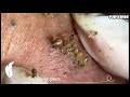 Dr pop   deep blackheads in old skin removing  treatment 2020 part 8