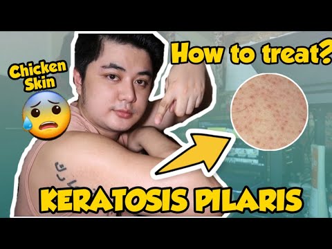 HOW TO TREAT KERATOSIS PILARIS ( Chicken Skin ) By Mark de Leon