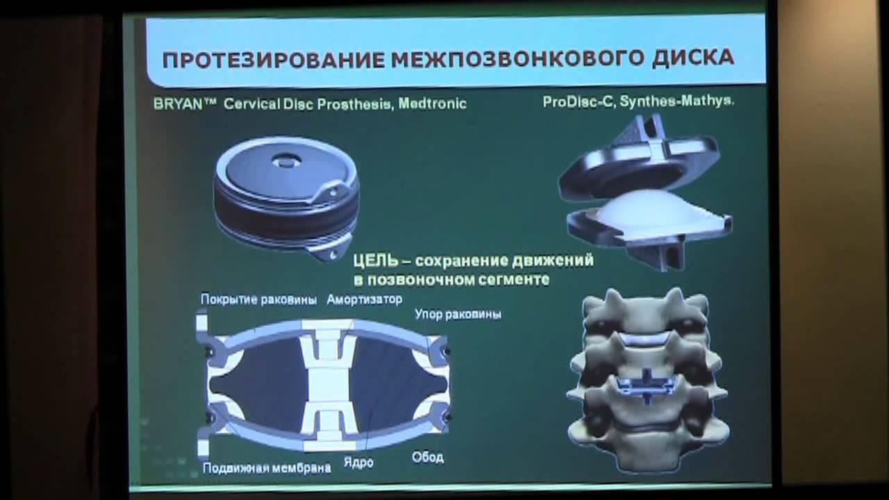 Операция замена дисков позвоночника