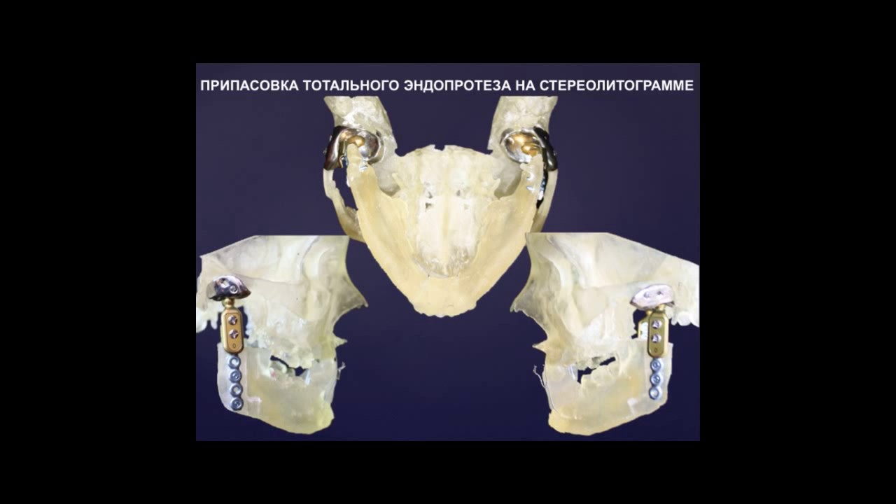 Устранение двухстороннего костного анкилоза тотальным эндопротезом