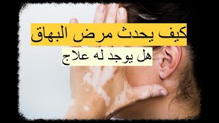 مرض البهاق - كيف يحدث مرض البهاق ؟ وما هي أنواعه وأعراضه وهل يوجد له علاج