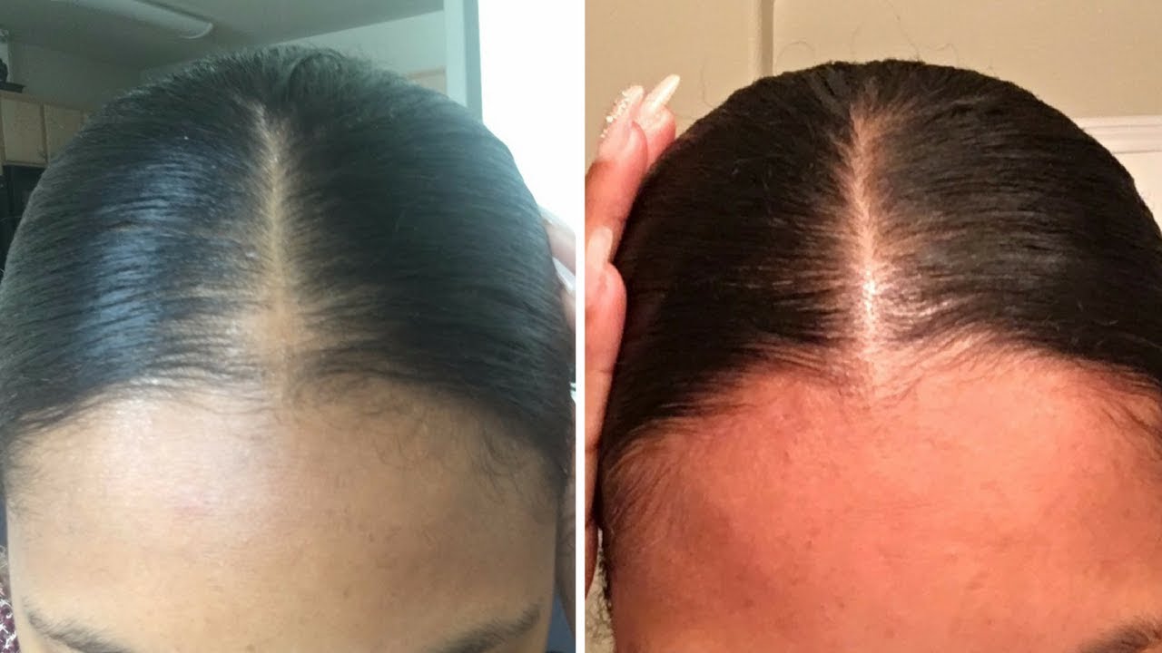 How I Gave Myself a Bald Spot and Grew it Back - thptnganamst.edu.vn