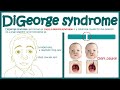 DiGeorge Syndrome 22q11 2 Deletion Syndrome Immunodeficiency