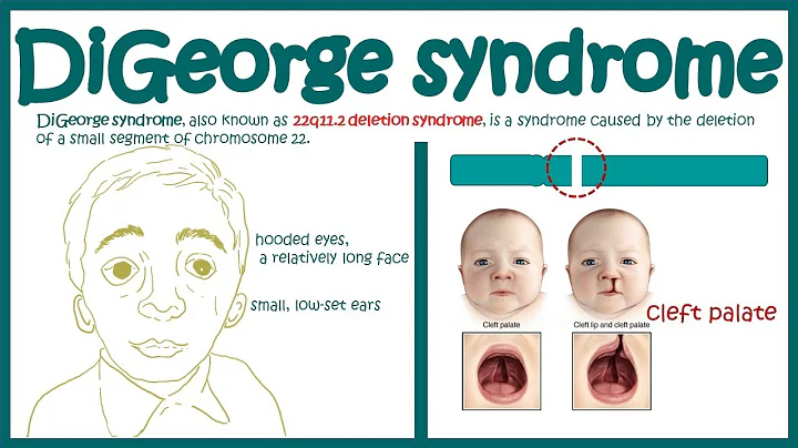 DiGeorge syndrome || 22q11. 2 deletion syndrome ||...