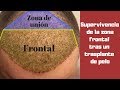 Supervivencia de folículos en la zona frontal tras un trasplante de pelo