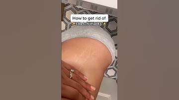 How To Get Rid Of Stretch Marks #beautyhacks #skincarehacks #lifehacks