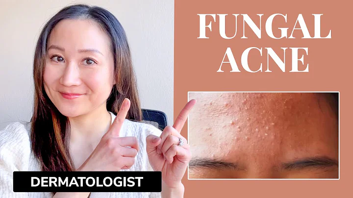 Dermatologist's Guide to FUNGAL ACNE | What is it? & Treatments