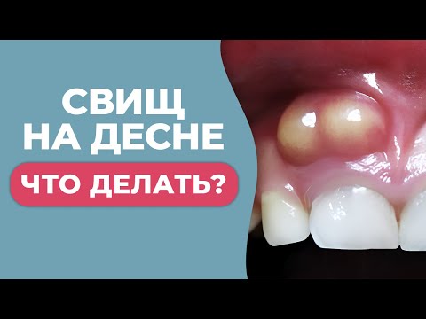 Video: Ima li cista gnoj?