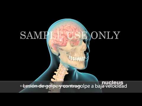 Video: ¿Qué causó la lesión cerebral de Sean?