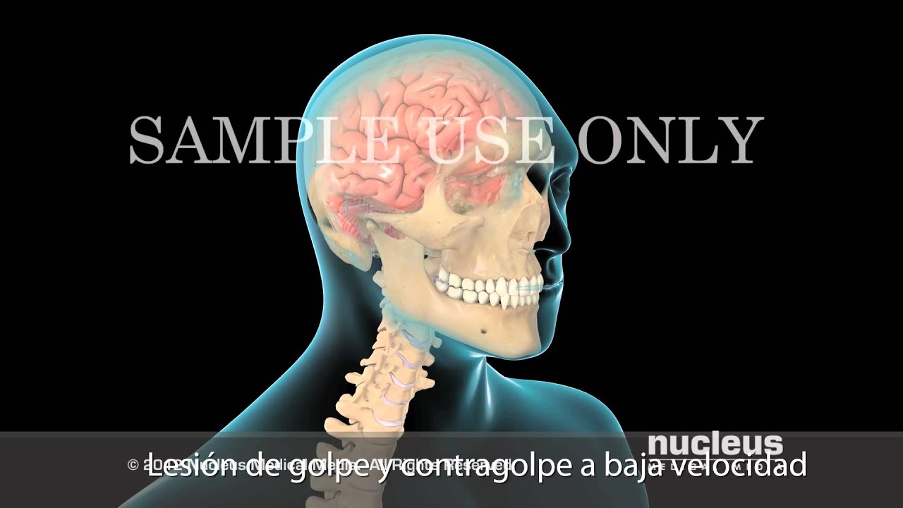 Signos de inflamación cerebral después de una conmoción cerebral