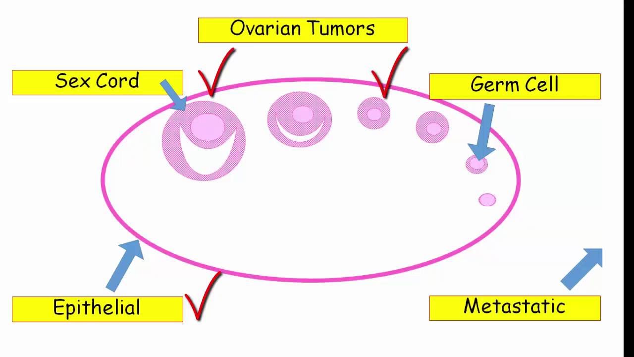 12DaysinMarch, Ovarian Tumors for USMLE Step One