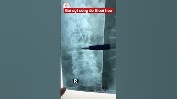 Hình ảnh gai cột sống thắt lưng do thoái hoá trên phim X - Quang.