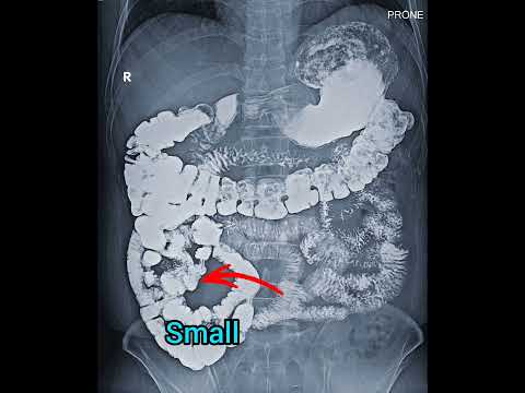 X ray Abdomen Anatomy #shortsvideo