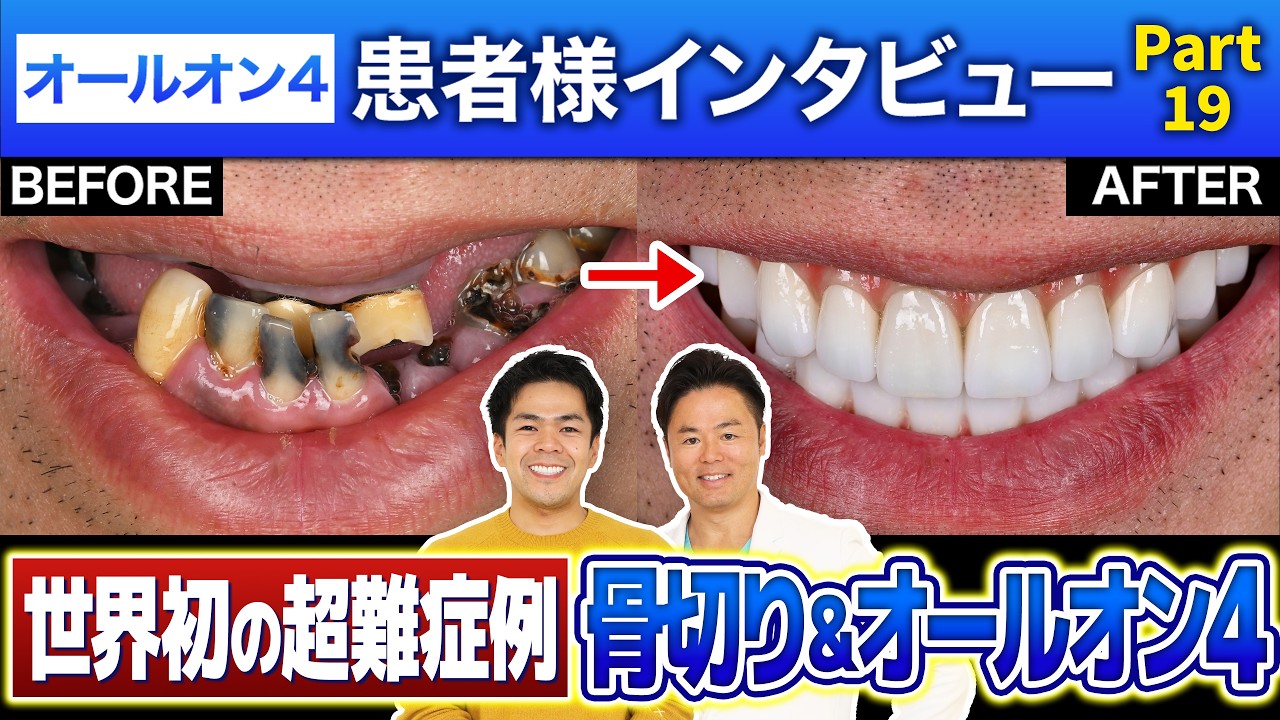 オールオン4モニター患者様 患者様インタビュー動画
