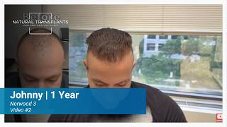 1 Year Hair Transplant Results, Fuller Hairline for Norwood 3 patient | Dr. Blumenthal (Johnny)
See the full 1 year hair transplant results from Natural Transplants with Dr. Blumenthal at the Washington DC Hair Restoration Clinic. In this follow up, Johnny returns one year after his procedure to share his honest experience, his hair transplant growth timeline, and how his results continued to improve in the later months.
Johnny explains that the early part of the hair transplant recovery process felt a little nerve-wracking, especially while waiting for the center and front hairline area to fill in. Around months 10 and 11, he noticed the front hairline getting thicker, which is a common part of the hair transplant results timeline. Dr. Blumenthal also explains that while many patients see strong results around 12 months, some continue to improve into months 13 and 14.
This video includes hair transplant before and after comparisons, close up views of the hairline, and honest patient advice for anyone considering hair restoration for thinning hair, a receding hairline, or male pattern hair loss. Johnny also shares that the discomfort was manageable and says his advice to anyone considering the procedure is simple, “I would just do it.”
Here is a link where you can go see Johnnys procedure day video: https://www.youtube.com/watch?v=Qlb_H0Cs9NA&t=36s
🔗 Connect with us:
Website: https://naturaltransplants.com/
Instagram: https://www.instagram.com/naturaltransplantsclinic/
Facebook: https://www.facebook.com/naturaltransplantsclinic/
X: https://x.com/NTHairClinic
Natural Transplants
Washington DC Hair Restoration Clinic
6410 Rockledge Dr #412
Bethesda, MD 20817
United States of America
Main: 844-327-4247
Local: 301-841-6005 1 Year Hair Transplant Results, Fuller Hairline for Norwood 3 patient | Dr. Blumenthal (Johnny)