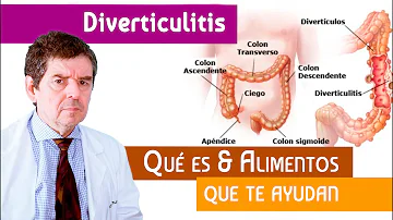 ¿Cuál es la mejor fibra para la diverticulosis?