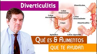 Diverticulitis. Qué es & Alimentos para mejorar esta condición.