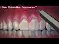 Igdp  chao   pinhole gum rejuvenation animation