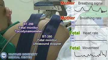 Noncontact Fetal Monitoring Using an IR UWB Radar Sensor, August, 2016.