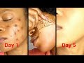 WHAT I USED THAT REMOVE MY DARK SPOTS IN JUST FEW DAYS YOU WILL NEVER HAVE DARK SPOTS AGAIN