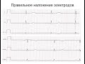 ЭКГ: неправильно наложенные электроды