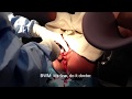 Birth video epidural and episiotomy
