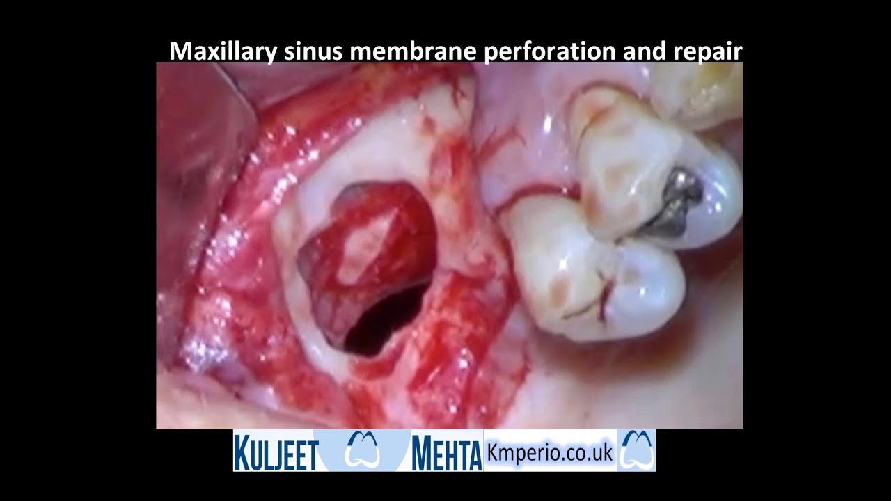Maxillary Sinus lift, Perforation and Repair-Part 1