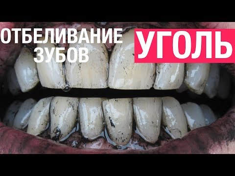 Как отбелить зубы в домашних условиях активированным углем