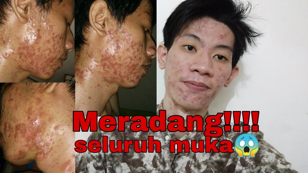 Jerawat meradang super parah dan motivasi pejuang jerawat
