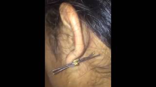 How to remove a stuck earring in ten seconds!