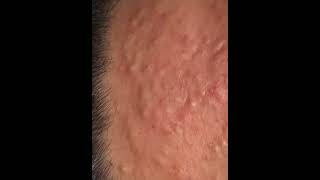 Pimple Popping Satisfaction