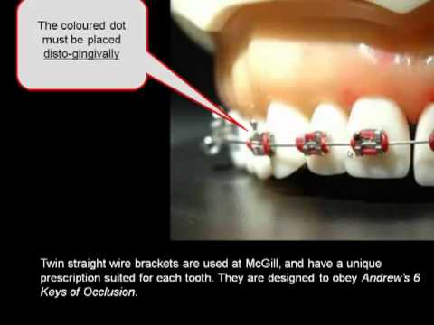 How important is the position of your orthodontic braces?