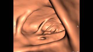 Ucsf Radiology What Virtual Colonoscopy Ct Scans Look Like