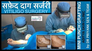 BEST VITILIGO SURGERY IN INDIA | सफ़ेद दाग सर्जरी कब करानी होती है ? Treatment by DR PRIYANK SEN .