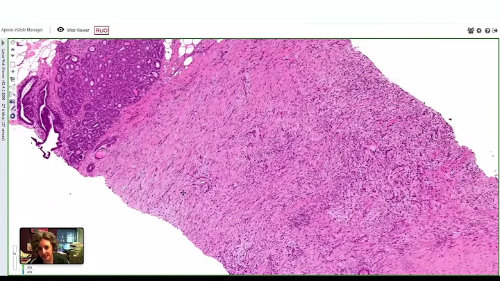 Breast Spindle Cell Lesions by Ashley Cimino-Mathews, M.D.