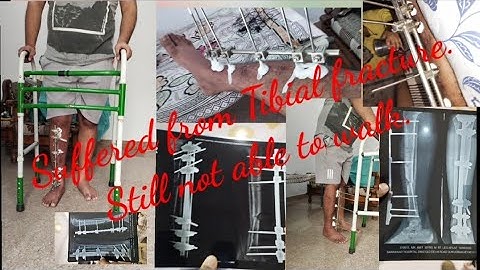 Fracture  !! Tibia and Fibula bone fracture and its infection ||| Recovery from Tibia fracture  |||