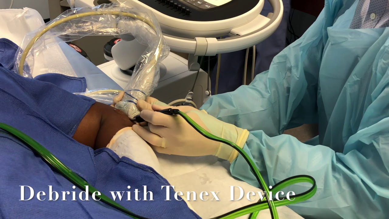 Partial Percutaneous Tenotomy of the Lateral Elbow Using the Tenex