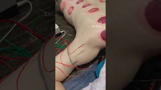 #accupuncture