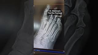 Find the fracture - fifth metatarsal base avulsion fracture and buried wire 5th Metatarsal Base Avulsion Fracture