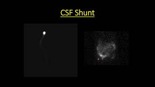 Brain Imaging in Nuclear Medicine