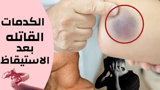 الكدمات الزرقاء في الجسم  معلومة قد تنقذ حياتك