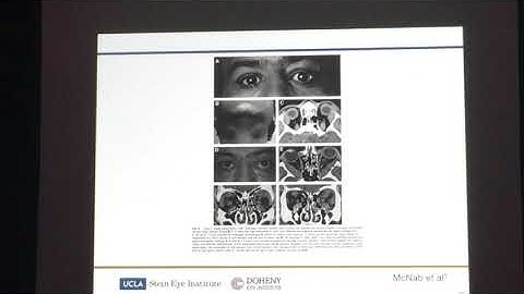 Benjamin Campbell, MD IgG4-Related Ophthalmic Disease