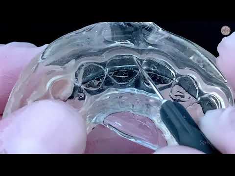 Injection molding technique with new GC G-ænial Universal Injectable & GC Exaclear