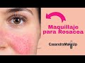 Que es la Rosacea y como maquillarla by CasandraMakeUp